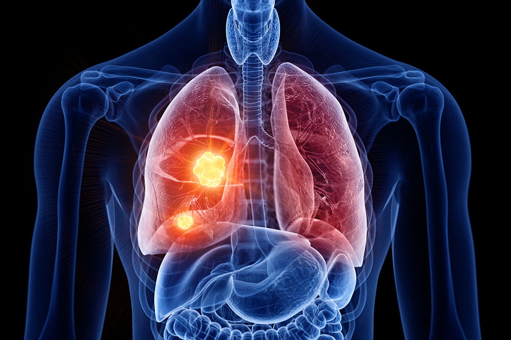 Lung Cancer Detection in Chest X-Ray Images Empowered by 3D Computed Tomography Deep Convolutional Radiomics (CXRClear)